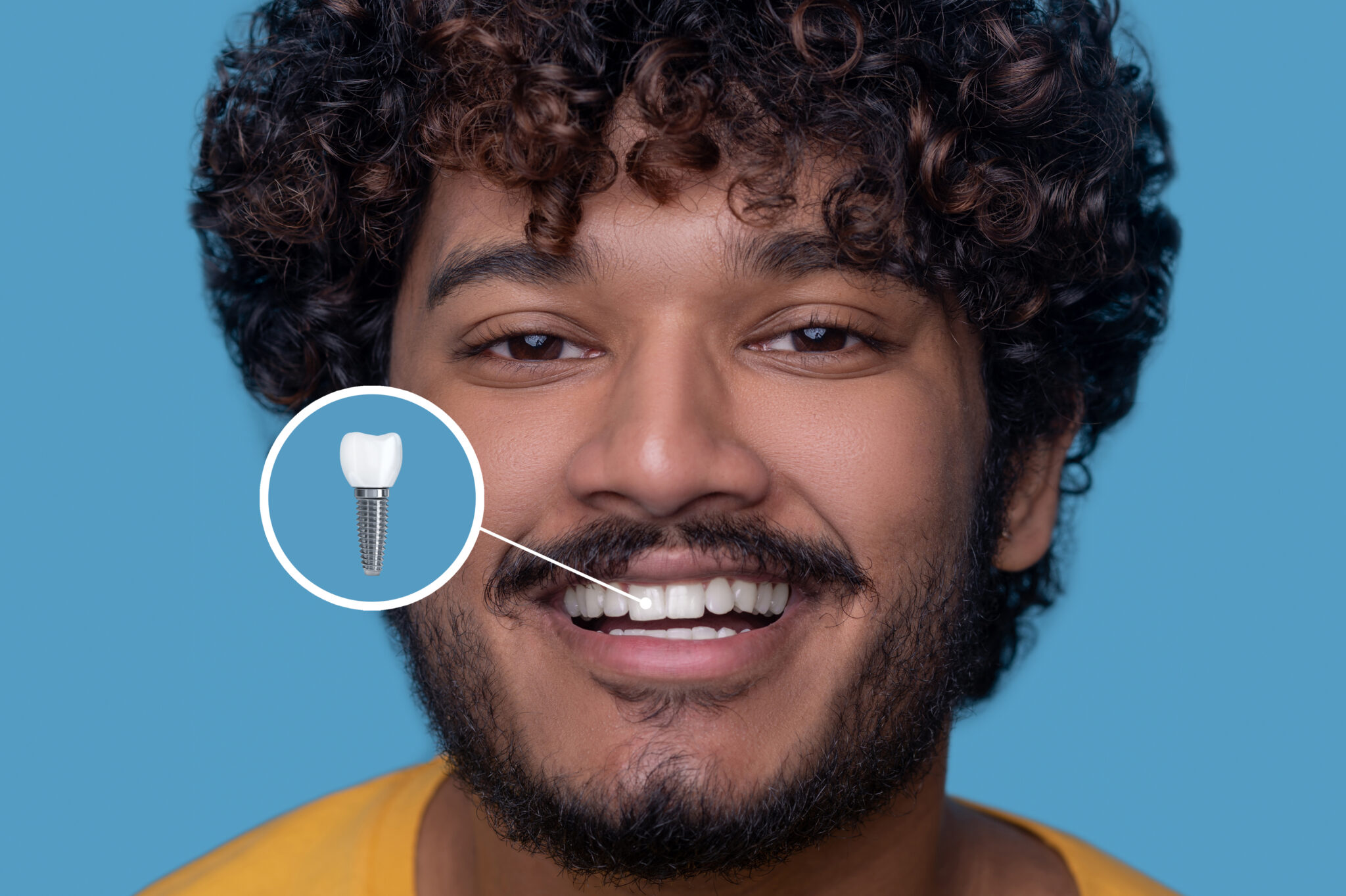 Implantes Dentários