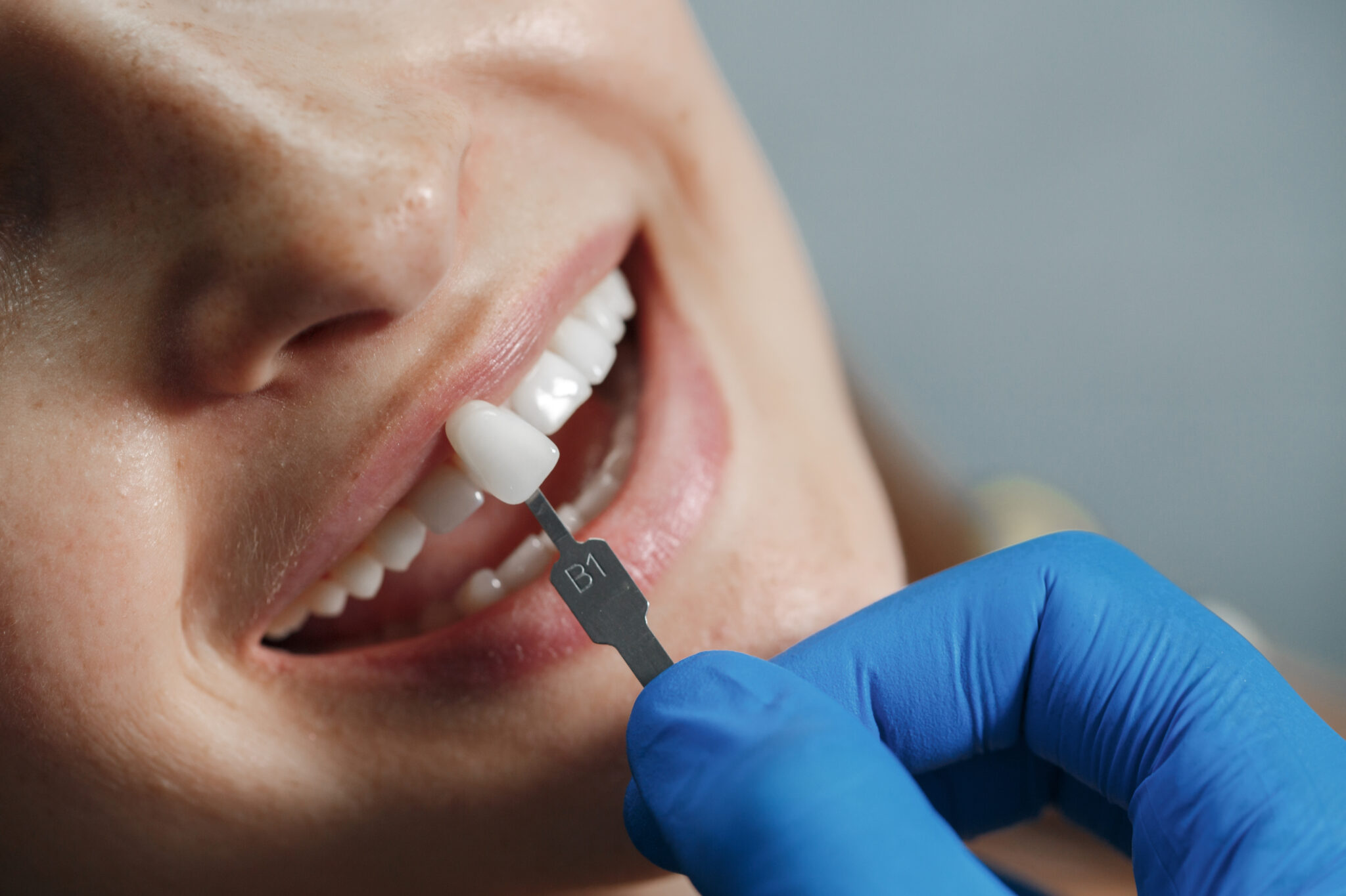 Lentes de Contato Dental